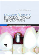 کتابContemporary Restoration ENDODONTICALLY TREATED TEETH Evidence Based Diagnosis and Treatment Planning 2013- نویسندهNadim Z. Baba